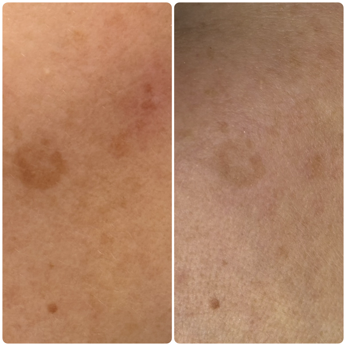 Лечение гиперпигментации после 1 процедуры IPL и сыворотки на основе транексамовой  кислоты 