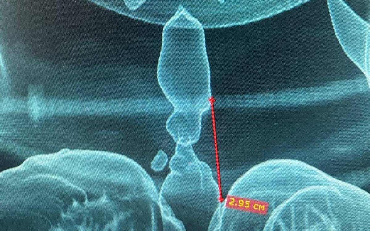    Хирурги в Ижевске восстановили дыхание жертве ДТП