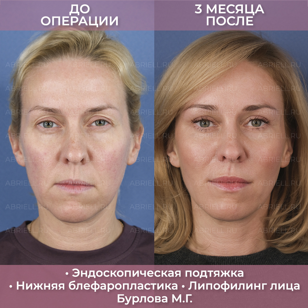 Омоложение лица эндоскопической подтяжка. Пластический хирург Бурлова Мария Григорьевна клиника Абриелль в Санкт-Петербурге 