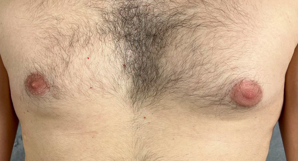 Лечение гинекомастии