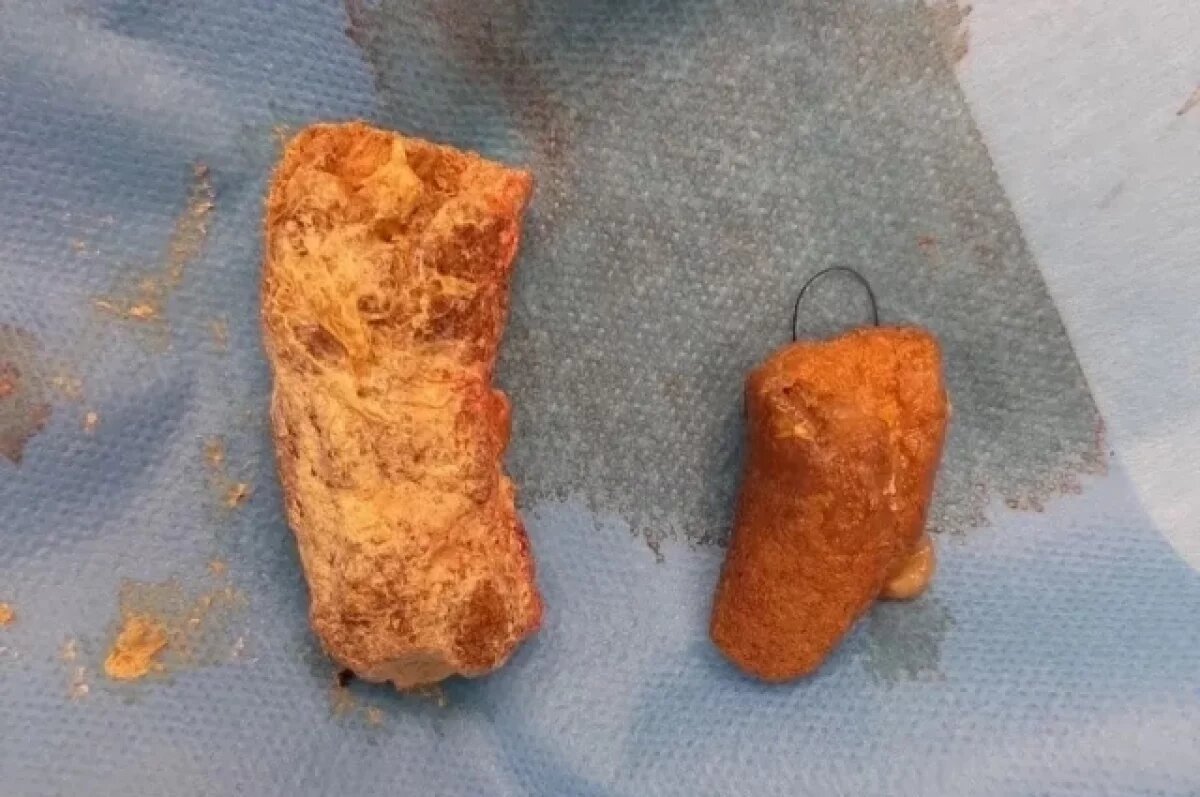    Фитобезоары