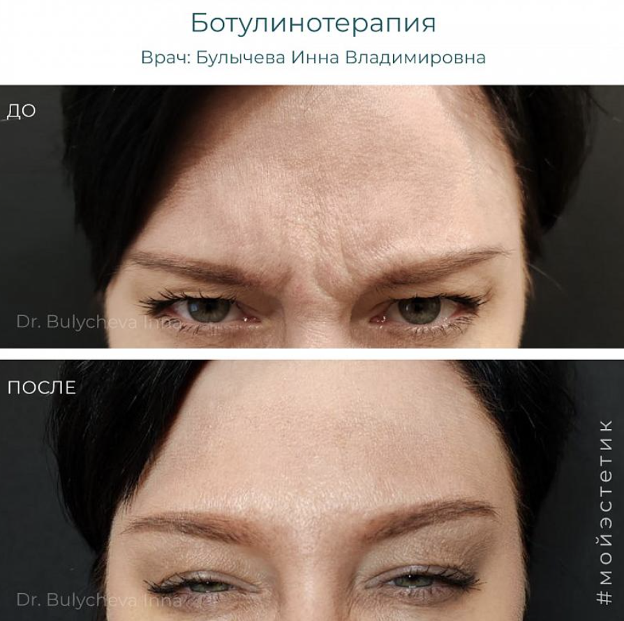 Результат ботокс-терапии (фото принадлежит Булычевой И.В)