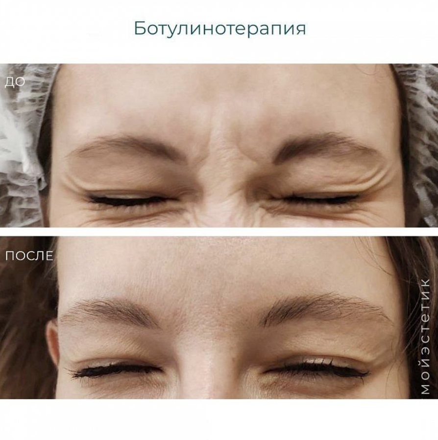 Результат ботокс-терапии
