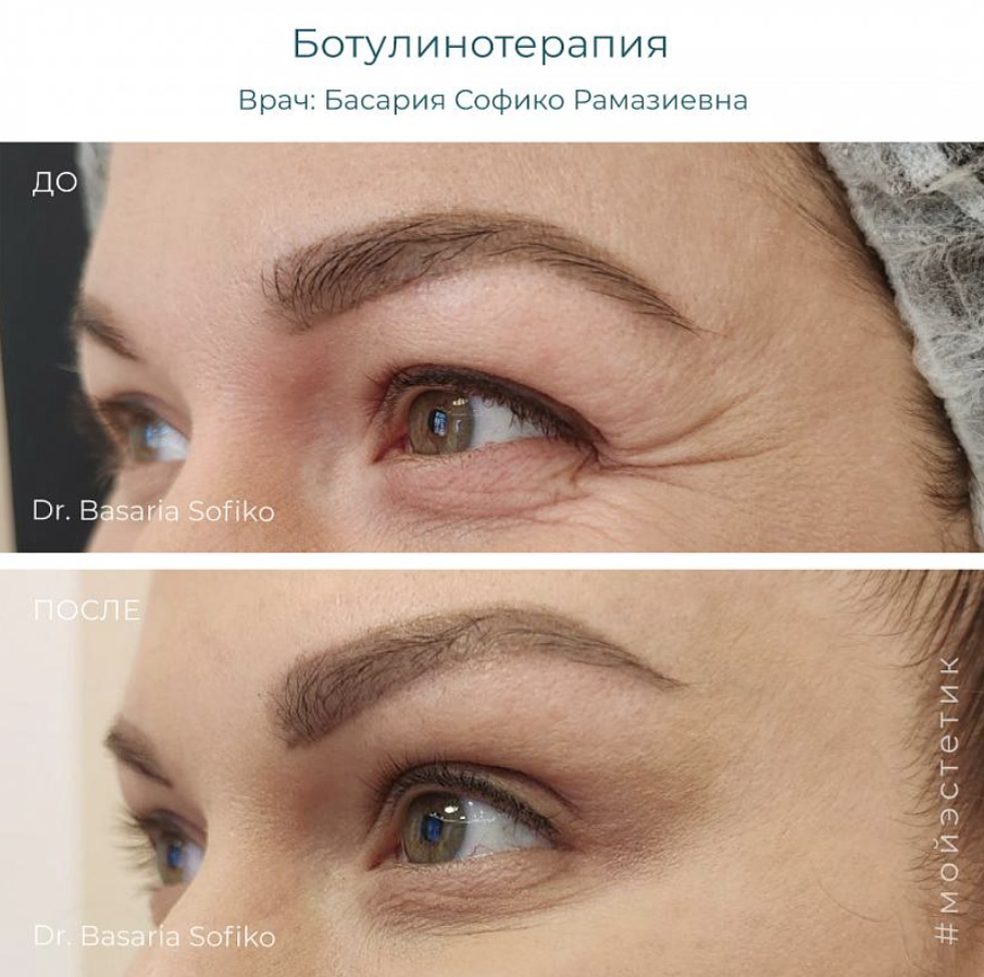  Результат ботокс-терапии (фото принадлежит Басарии С.Р.)