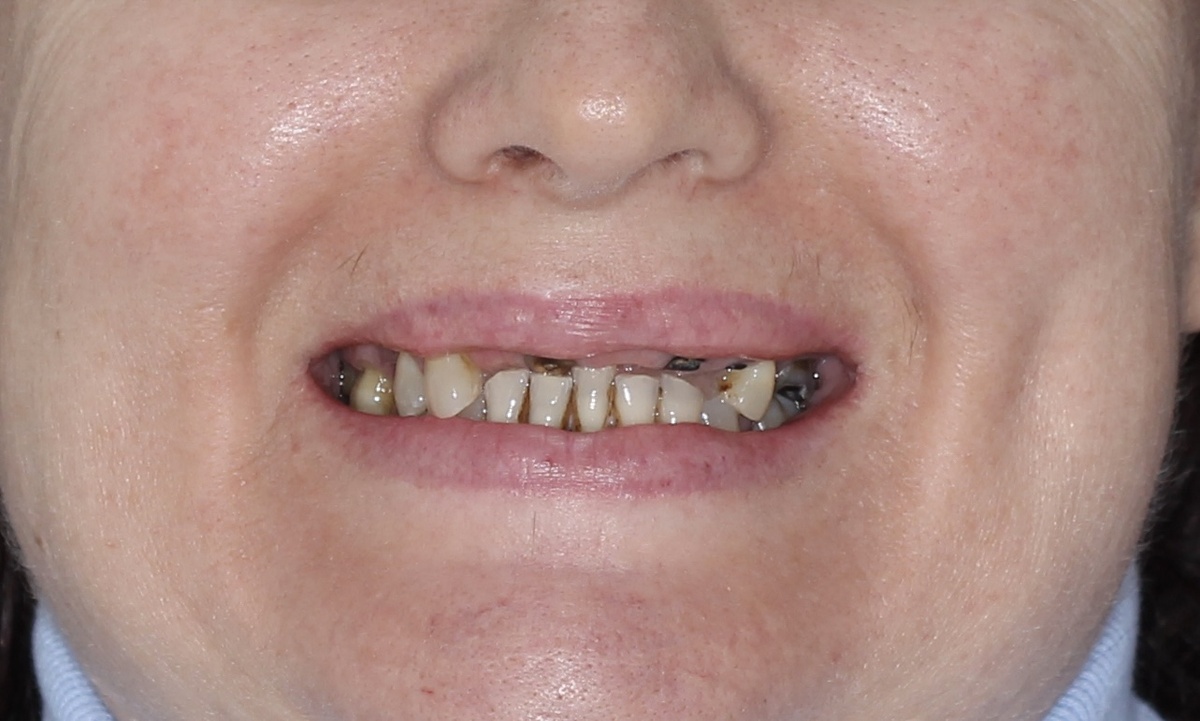 Состояние зубов до лечения. Листайте карусель.