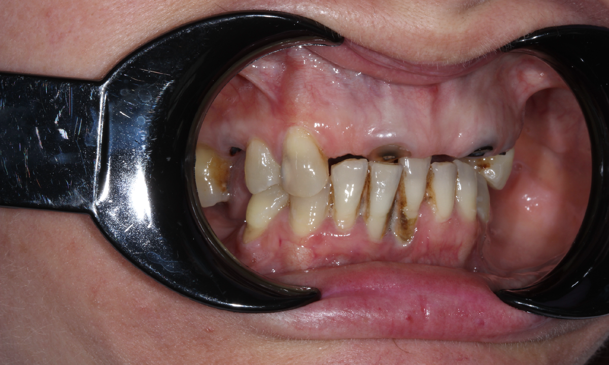 Состояние зубов до лечения. Листайте карусель.