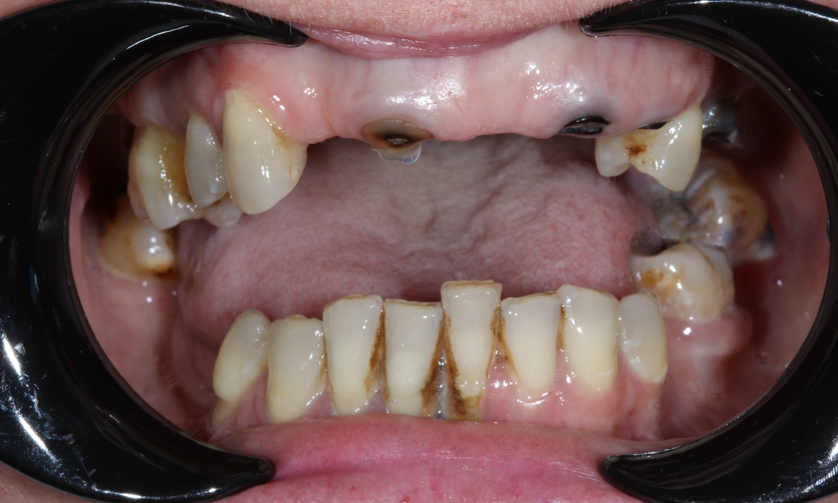 Состояние зубов до лечения
