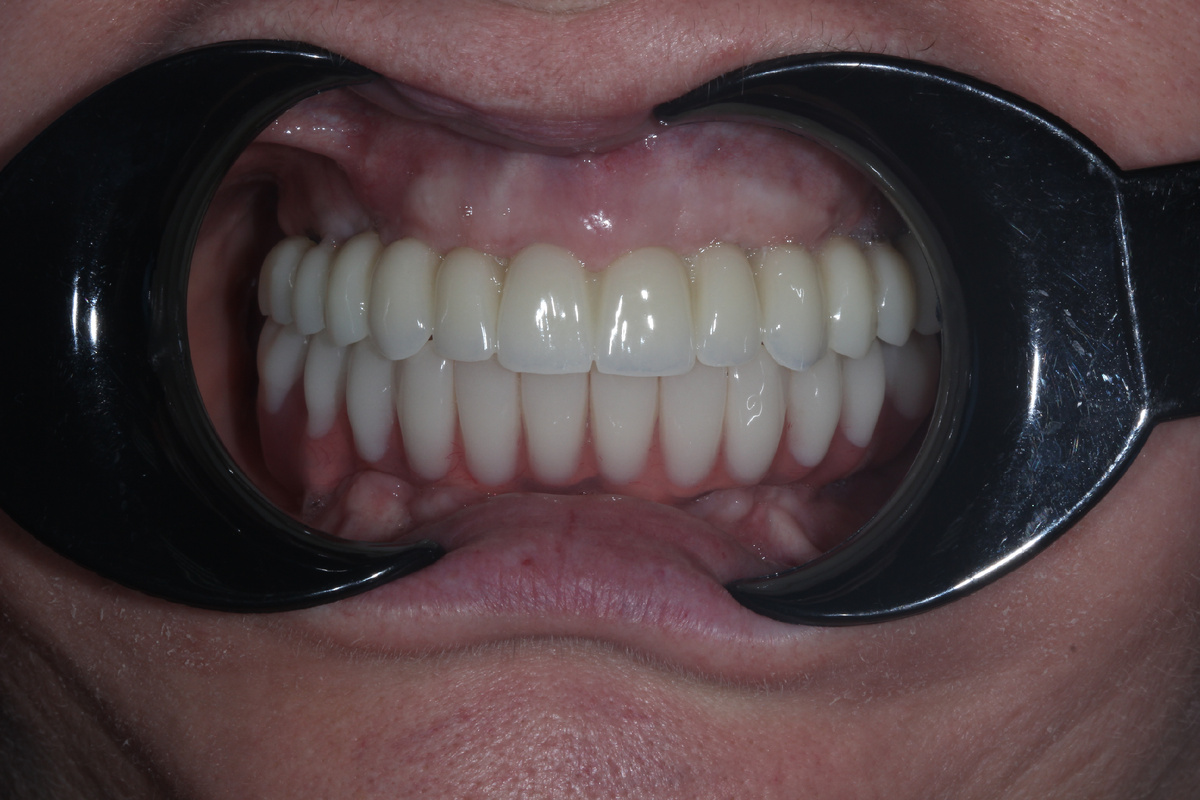 Состояние улыбки после восстановления челюсти с помощью циркониевой конструкции на верхней челюсти и титано-композитного протеза на нижней челюсти