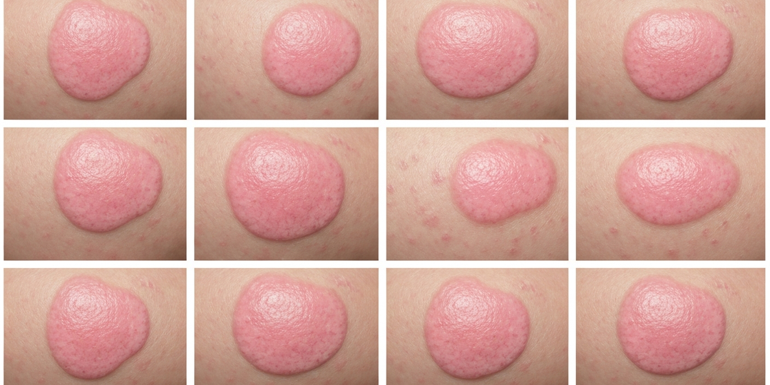 Первые симптомы псориза — визуальные признаки