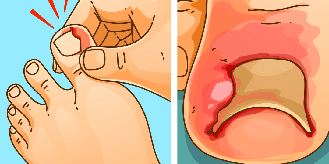 Что делать если болит вросший ноготь? Мнение подолога с 16-летним стажем