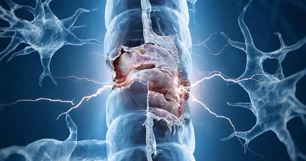 Синдром Гийена-Барре: когда иммунитет атакует собственные нервы