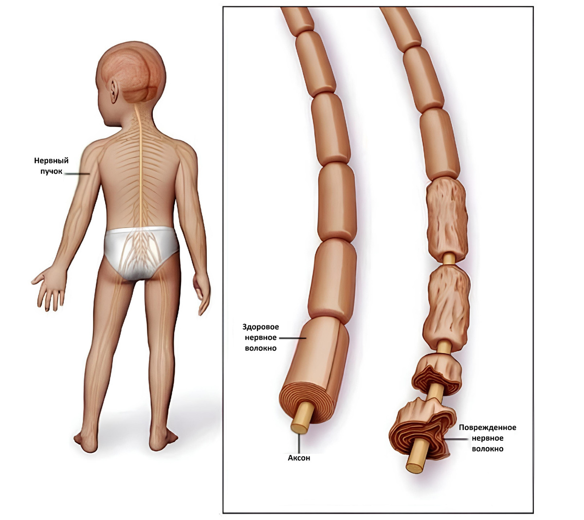 Аксон нейрона в норме и при синдроме Гийена - Барре