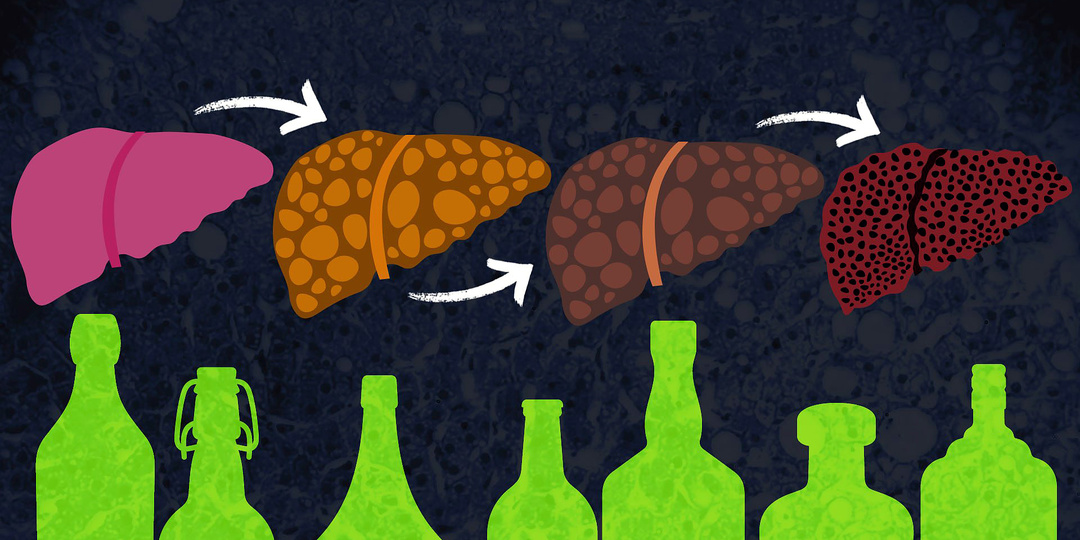 Алкогольная болезнь печени: симптомы и стадии. Как понять, что печень умирает?