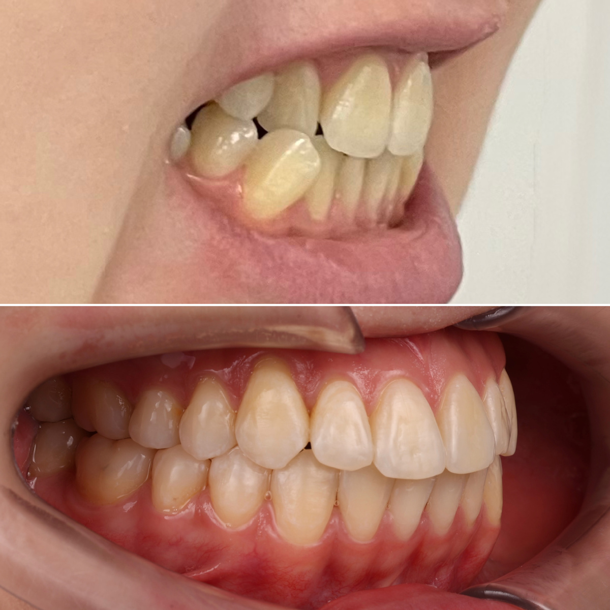 Клык добыли, он теперь в зубном ряду!