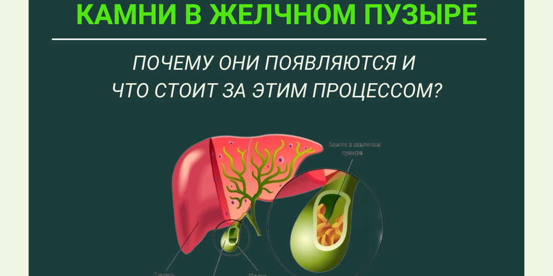 Камни в желчном пузыре: почему они появляются и что стоит за этим процессом?
