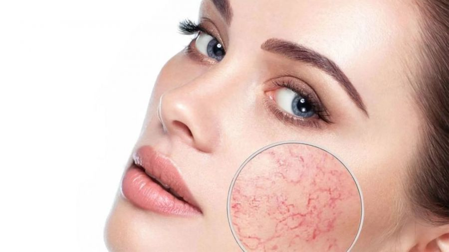 Лазер позволяет точечно воздействовать на расширенные сосуды и убрать их, не повреждая окружающие ткани и без длительного восстановления.