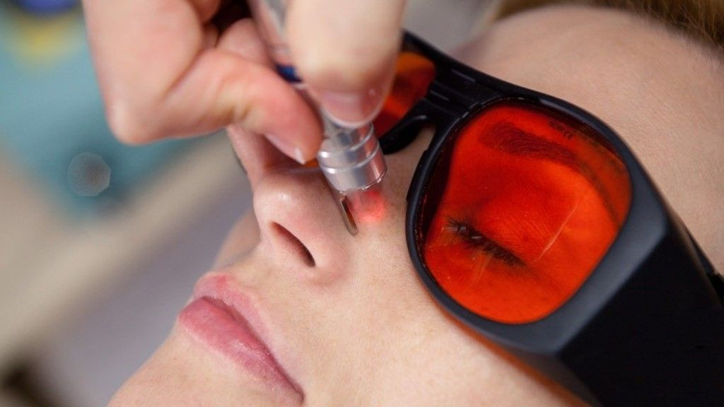 Лазерное лечение купероза подходит не всем, поэтому перед процедурой обязательна консультация врача для оценки показаний и противопоказаний.