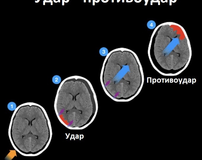 Двойной удар: механизм противоударной травмы головы на примере из практики