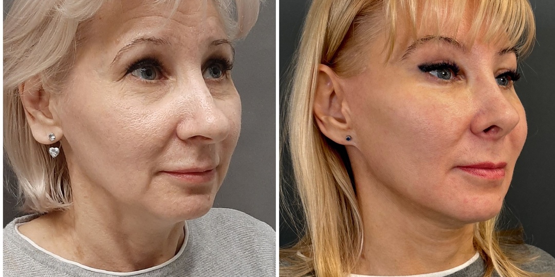 Фейслифтинг(подтяжка лица): результат 3,5 года после операции