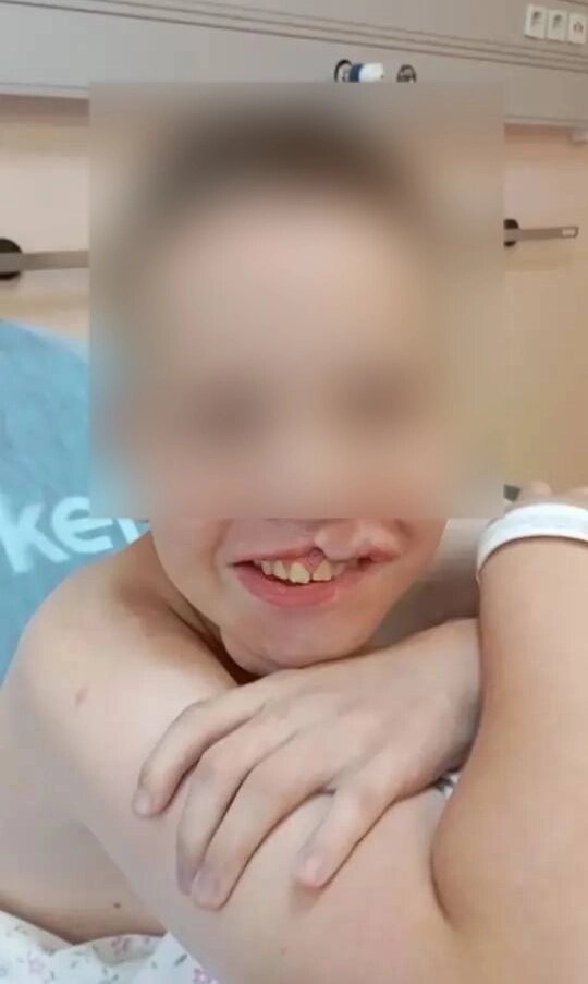    Так Кирилл выглядел после первой пластической операции. Фото: АиФ