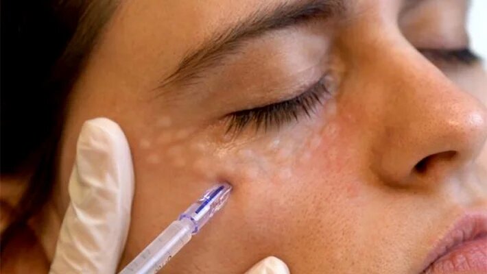 Так выглядят папулы при мезотерапии зоны вокруг глаз