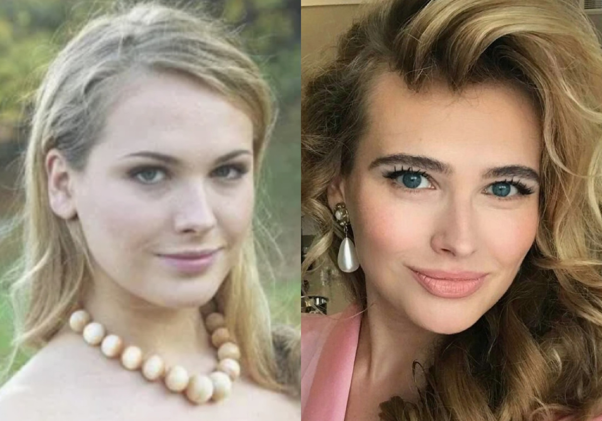 на фото Анна Горшков до и после пластики