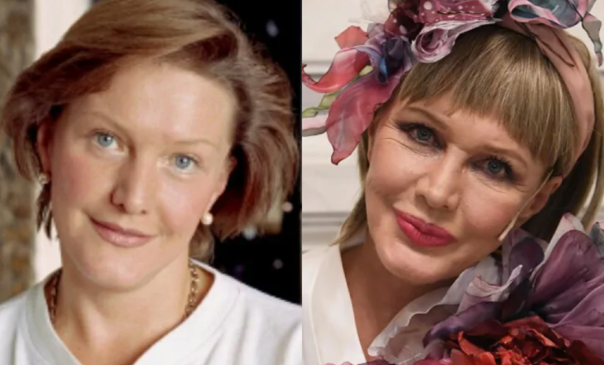 на фото Елена Проклова до и после пластики