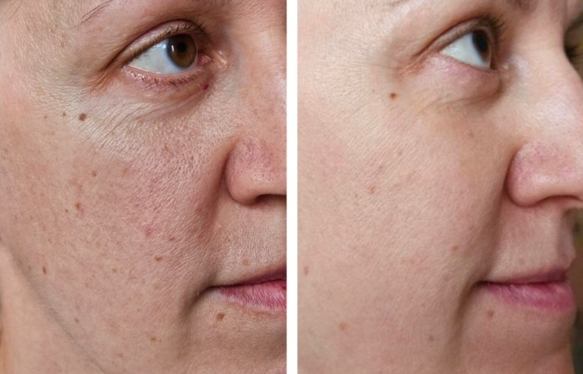 Поэтапный подбор и результат за полгода!