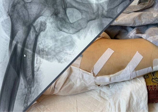 Пенсионерка получила тяжелую травму и скончалась через неделю в больницеИсточник:предоставлено семьей погибшей