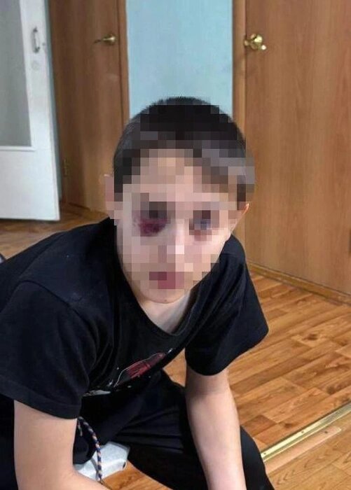 Лицо мальчика мы вынуждены размыть, но и так видно, какие синяки у него под глазамиИсточник:телеграм-канал «Воронцова вещает»