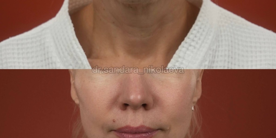 6 месяцев после фейслифтинга и лобно-височного лифтинга