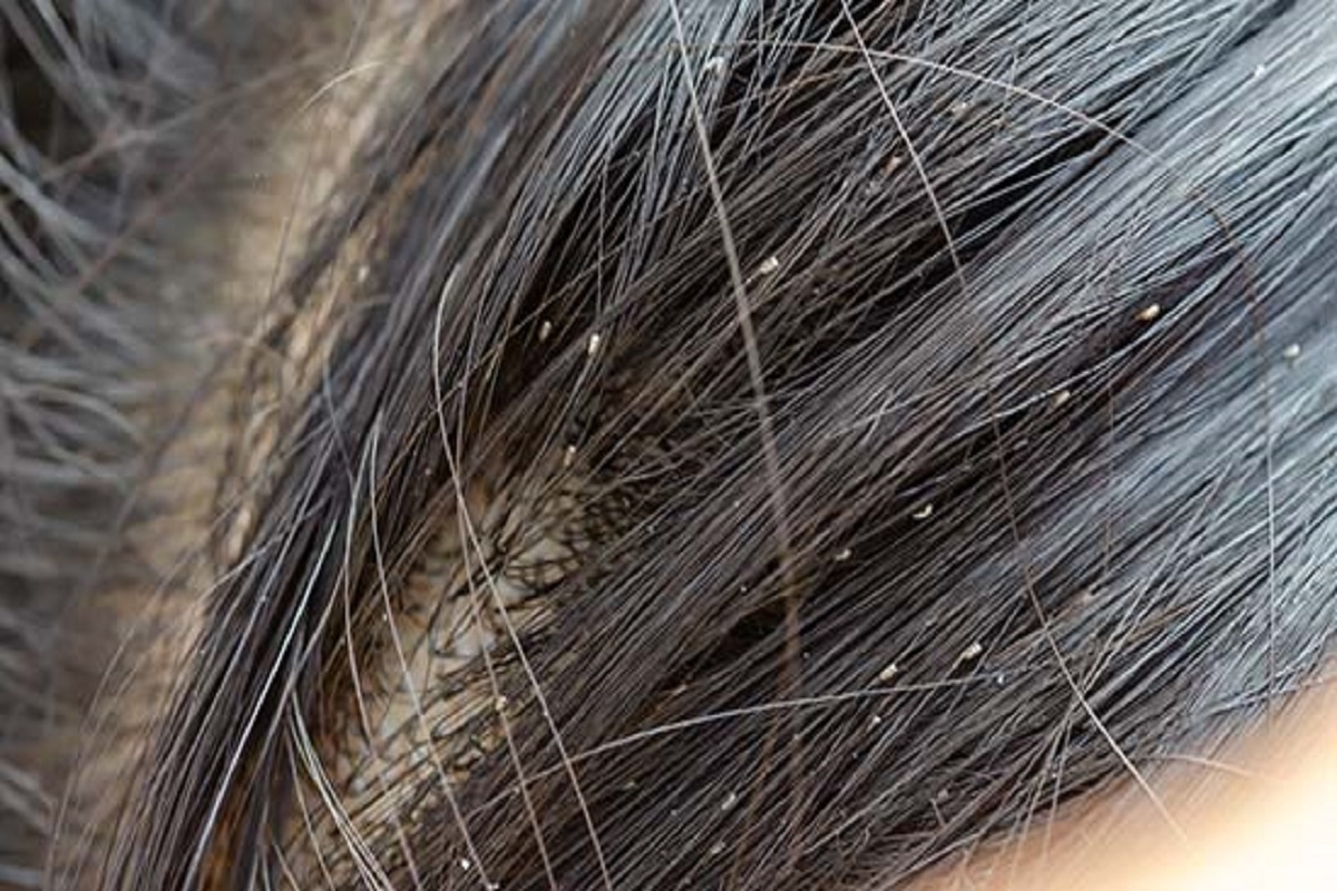 Фото с сайта: https://www.patrika.com/amp/home-and-natural-remedies/home-remedies-to-get-rid-of-lice-in-hair-7504711