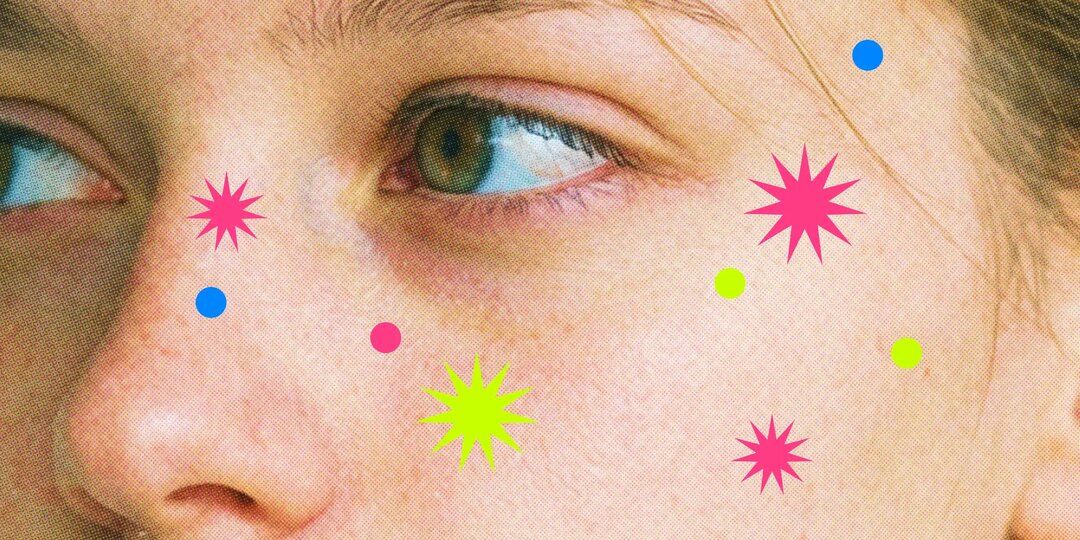 Как избавиться от прыщей: пошаговый план для подростков и их родителей