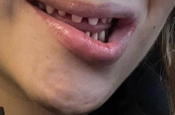 Россиянка пожаловалась на осложнения после установки виниров в Турции. Фото © Telegram/ BAZA