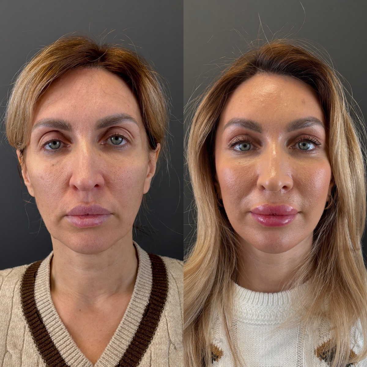 Комплексное хирургическое омоложение лица: результат 1 месяц после операции: слева-до, справа- после. Хирург к.м.н. Остринская Т.В.
