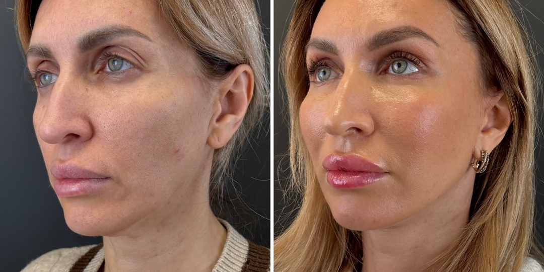 Комплексное омоложение лица: результат от 2 недель к 2 месяцам