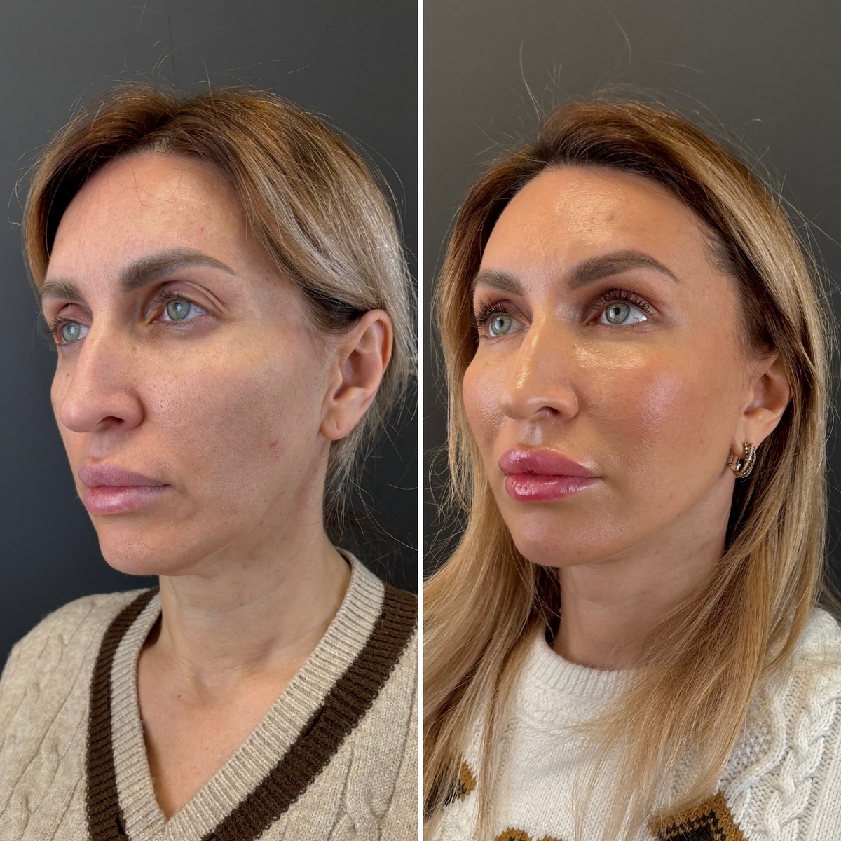 Комплексное хирургическое омоложение лица: результат 1 месяц после операции: слева-до, справа- после. Хирург к.м.н. Остринская Т.В.