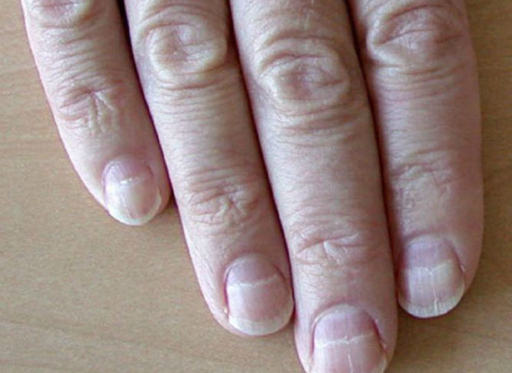 Что такое линии Мюрке на ногтях?