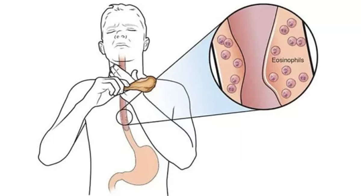 Еда застревает в горле? Как кусок стейка едва не стоил мужчине жизни и почему нельзя запивать еду водой
