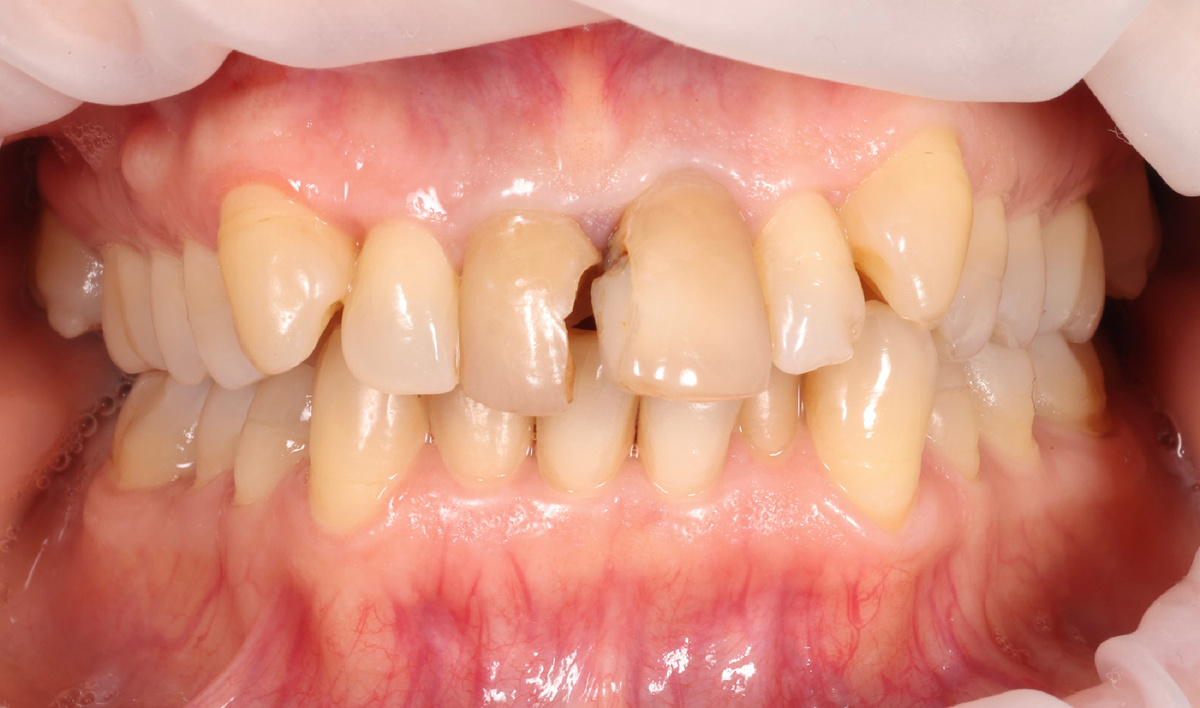 Разрушенные коронковые части зубов 1.1 и 2.1