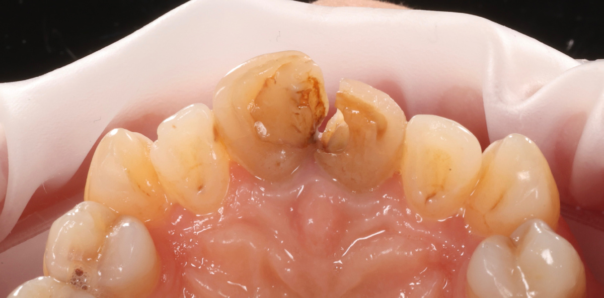 Состояние резцов до, вид со стороны нёба