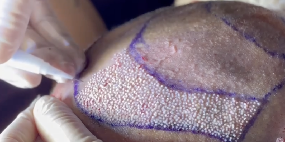 5 методов пересадки волос, но FUE - это не техника имплантации волос.