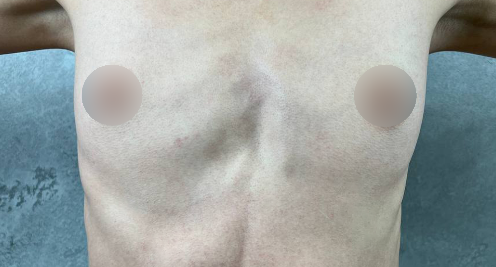 Результат увеличения груди