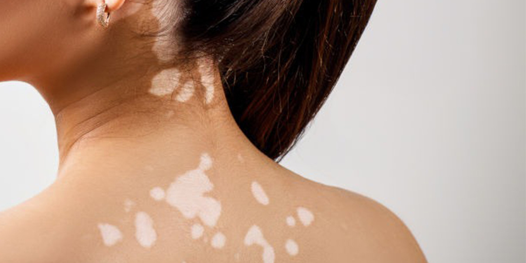 Витилиго: болезнь, которая оставляет след не только на коже