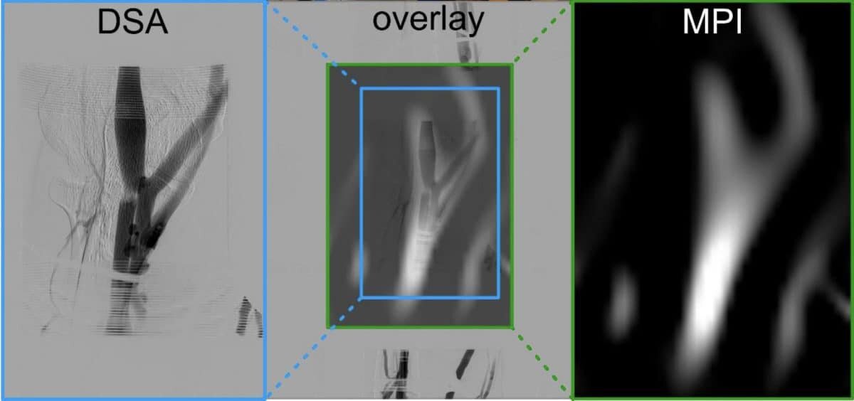    Два метода визуализации вен руки в сравнении: слева традиционная рентгеновская ангиография (DSA), справа — магнитно-частичная томография (MPI). В центре — наложение снимков, демонстрирующее, что новый метод отображает те же сосуды, что и рентген, но без ионизирующего излучения. / © Patrick Vogel (2026)