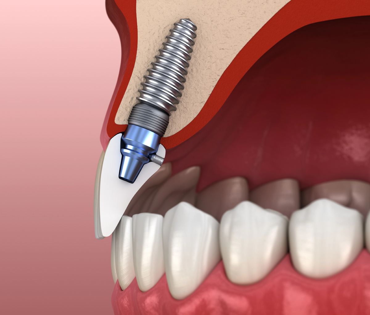 Коронка на импланте