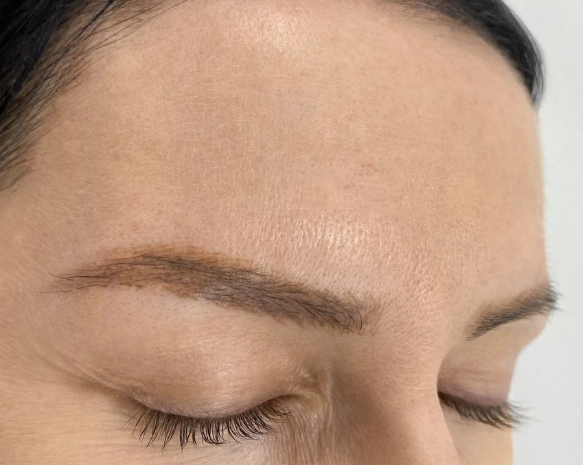 В процессе удаления Микроблейдинг, через месяц после первого сеанса, на фото ниже через месяц после второго сеанса.