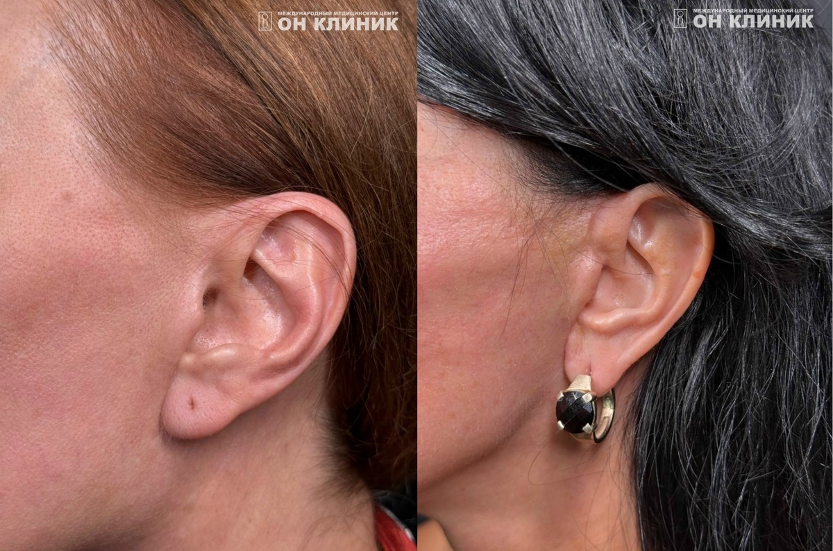 Фото шрамов после операции – смас-лифтинг лица