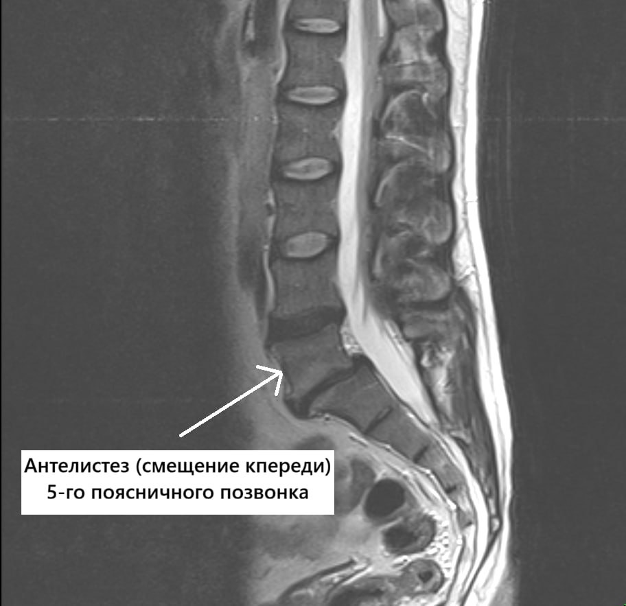 Результаты МРТ пояснично-крестцового-копчикового отдела позвоночника.
