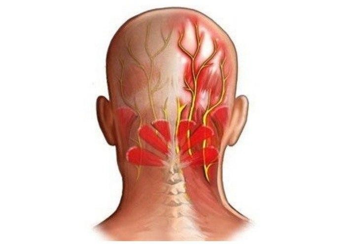 Ваша шея - причина головных болей? Проверьте себя за 2 минуты